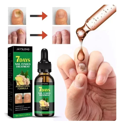 Nura — Aceite de Uñas para Hongos (Fórmula Intensiva Tea Tree)